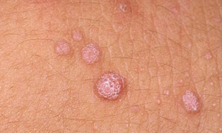 HPV viib naha papilloomide ilmnemiseni